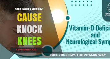 Exploring the Link: Vitamin D Deficiency and Knock Knees