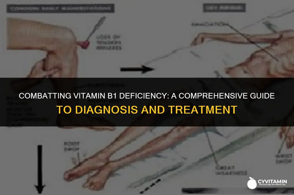 how to cure vitamin b1 deficiency
