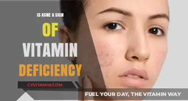 Could Your Acne Be a Sign of Vitamin Deficiency?