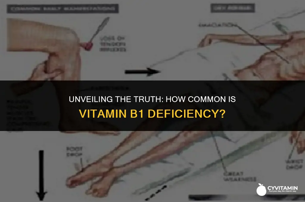 is vitamin b1 deficiency common