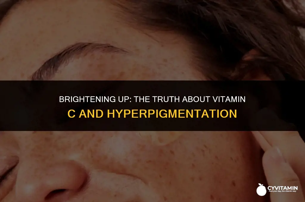 is vitamin c good for hyperpigmentation