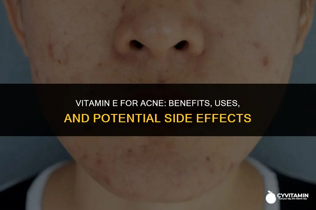 is vitamin e good for pimples