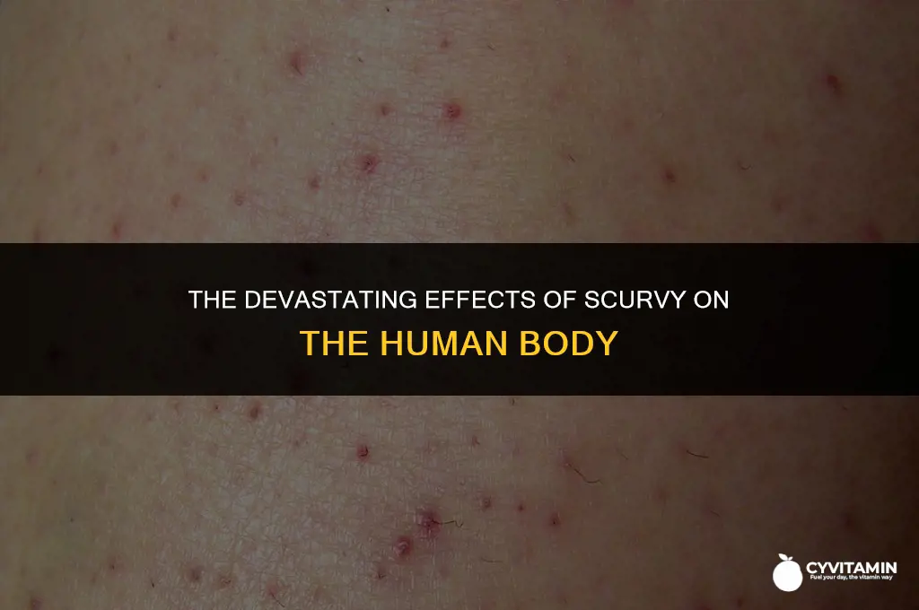 what does scurvy do to the body