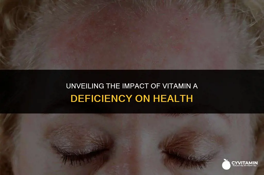 what happens in a vitamin a deficiency