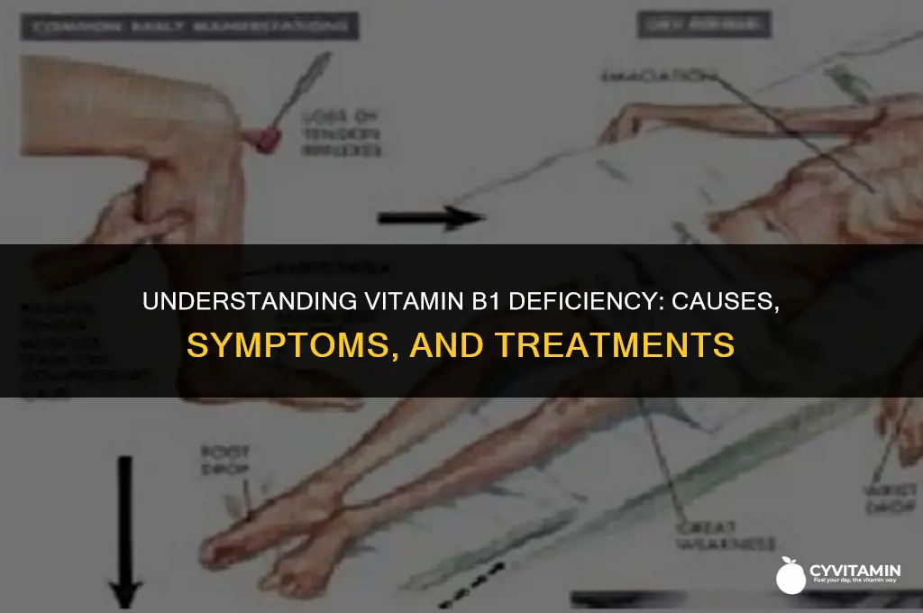 what is a vitamin b1 deficiency