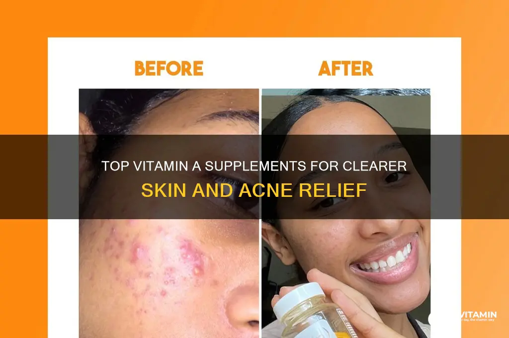 what is the best vitamin a supplement for acne