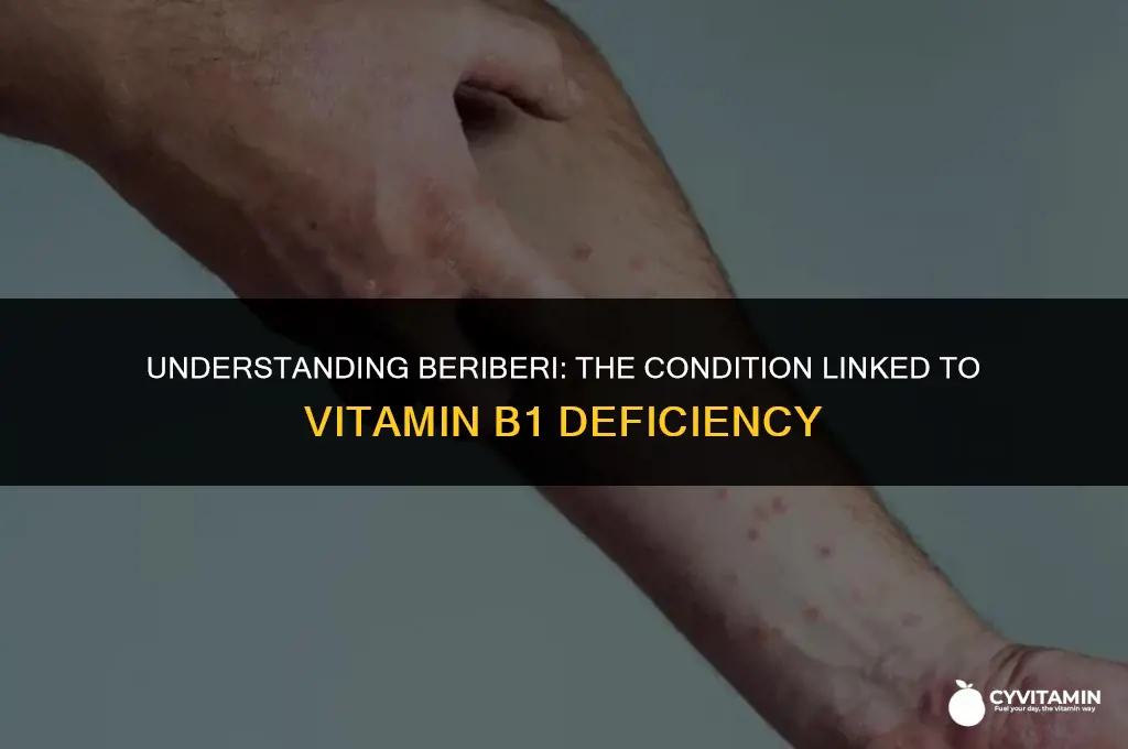 what is vitamin b1 deficiency called