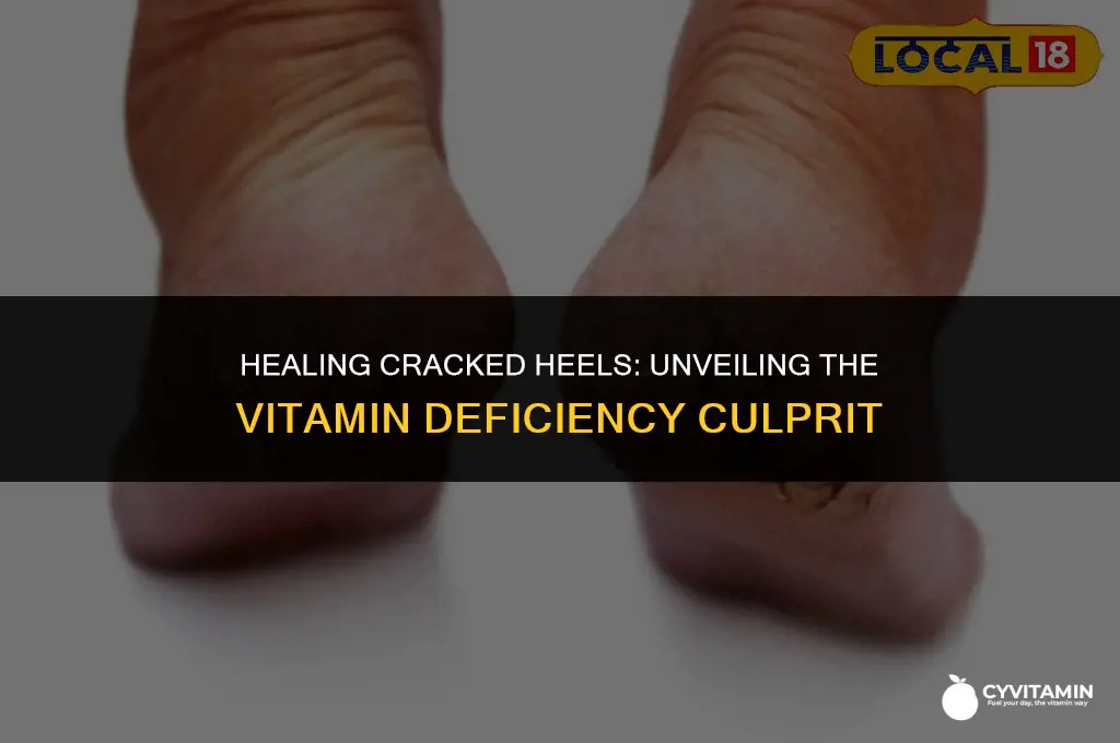 what vitamin deficiency causes cracked heels
