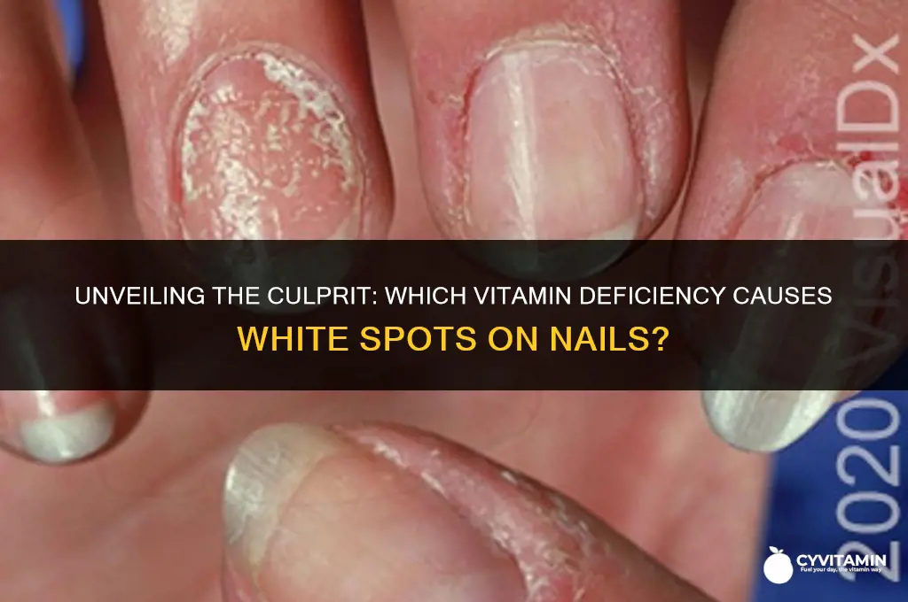 what vitamin deficiency causes white spots on nails