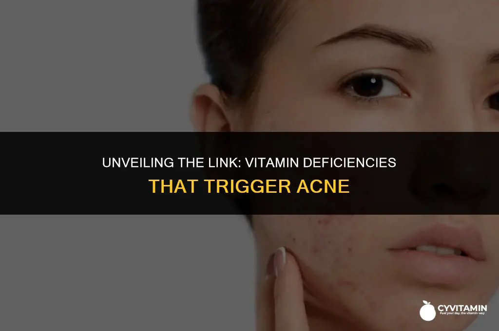 what vitamin deficiency is associated with acne