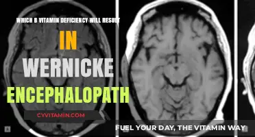 Unveiling the Link: B Vitamin Deficiency and Wernicke Encephalopathy