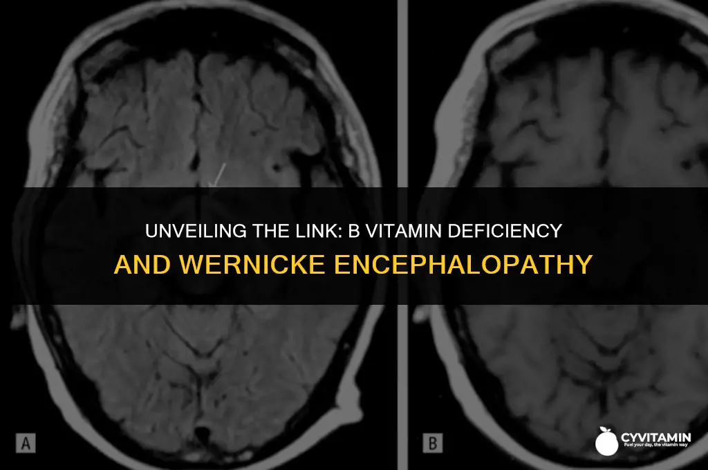 which b vitamin deficiency will result in wernicke encephalopathy
