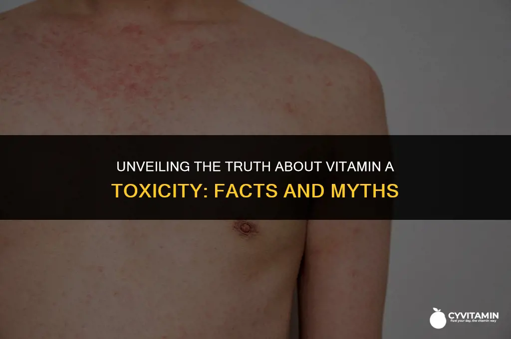 which of the following is true about vitamin a toxicity